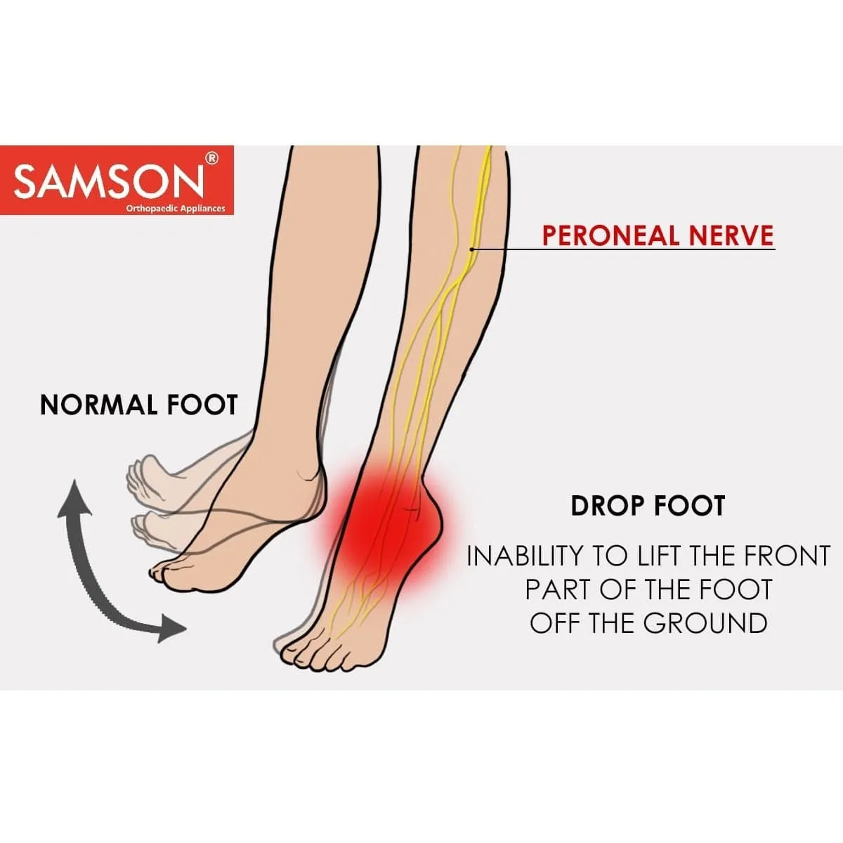 Samson Foot Drop Splint - (Custom Fit, Light Weight, Thin Wall Construction for Effective Support) (For Men & Women)